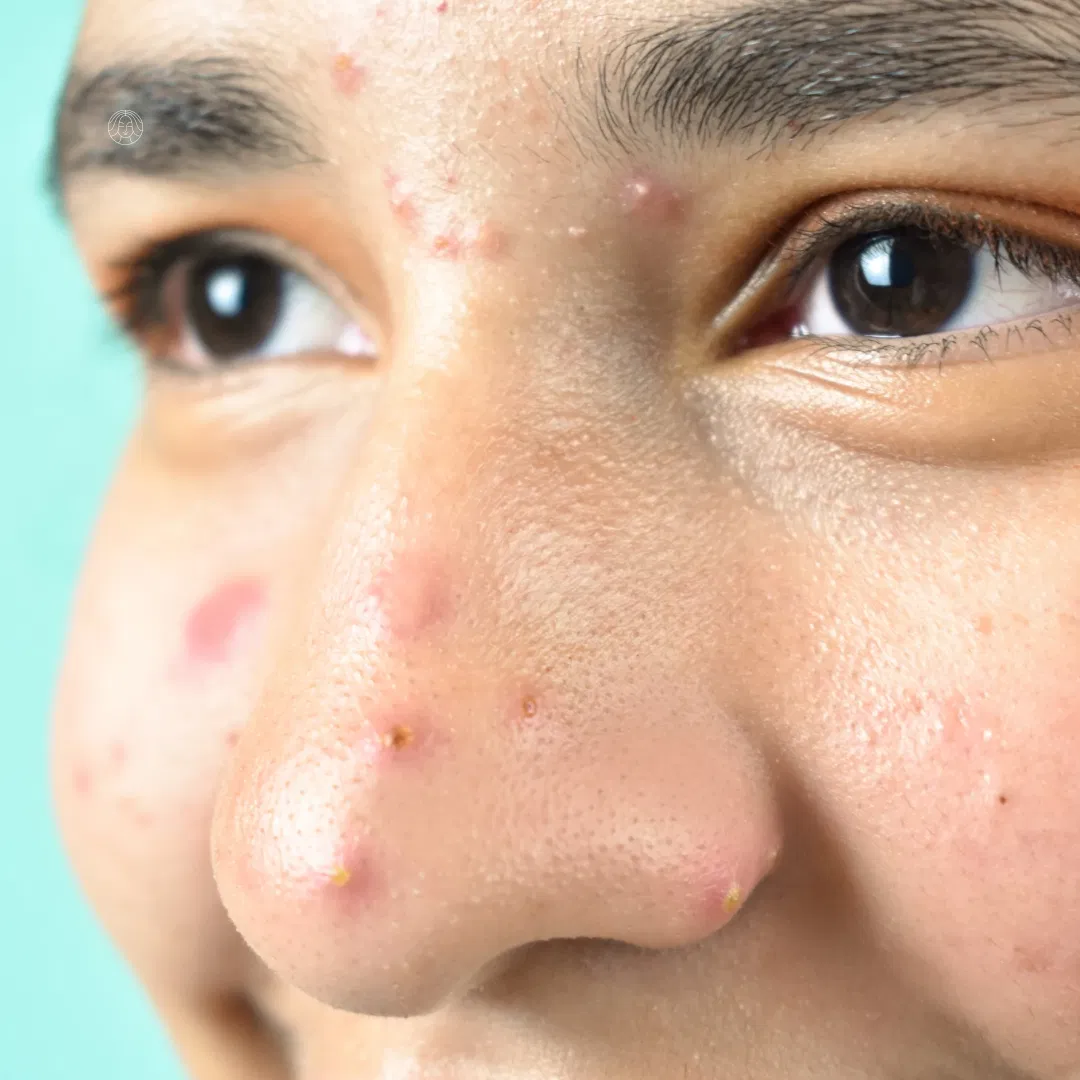 Stellar Clarity Facial (Acne)